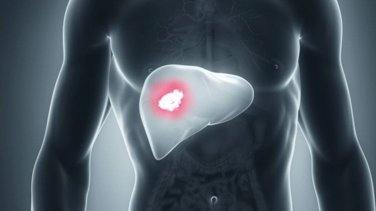 Cancer hepatic (carcinom hepatocelular): simptome, cauze și tratament Cancerul hepatic (carcinom hepatocelular)