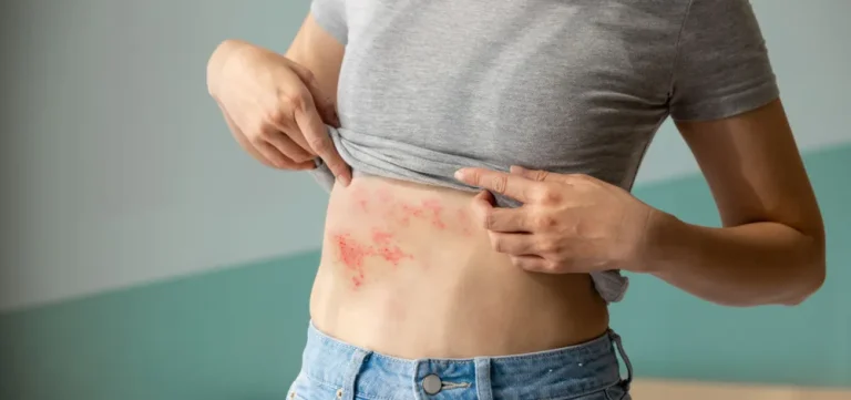 Zona Zoster: Simptome, Cauze, Tratament și Prevenție Zona zoster